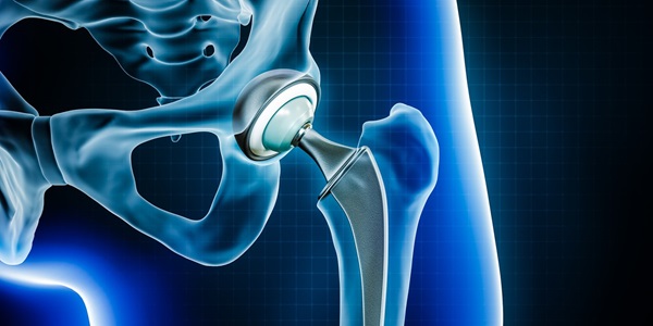 Why Total Hip Replacement Surgery